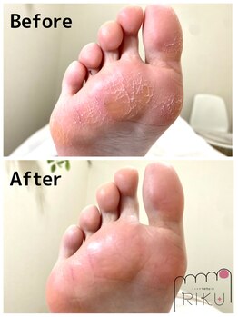 りく/角質ケア45分