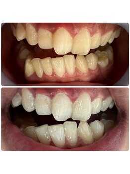 ラブホワイトニング 渋谷店(LOVEホワイトニング)/初回2回照射ホワイトニング