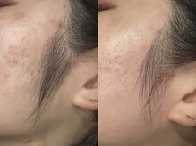 ウー(Wu)/wax脱毛(もみあげ)