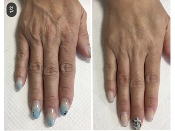 ハンドエステ ビフォアフ