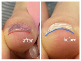 巻き爪にお悩みの方へオススメ