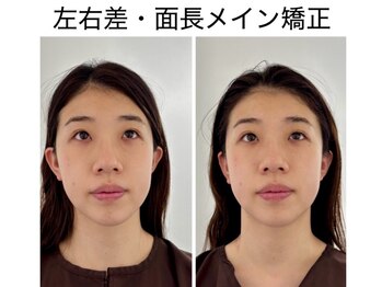 エレヴィザ トウキョウ 恵比寿院(ELVISA TOKYO)/左右差・面長改善 / 初回施術