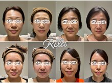 リタ 銀座(Rita)の雰囲気（最新☆ホワイトスノーピールで小顔！つやつや水光肌へ導きます！）