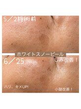 ココ 2号店(CoCo)/ホワイトスノーピール　改善例