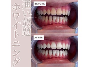 エクシアホワイトニング 草津店/ホワイトニングビフォーアフター