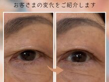 エステサロン プラスエー(+A)/リフトアップ/たるみ/ハリ