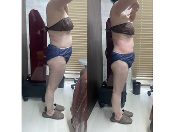 ビューティースペース 品川大井町店(Beauty Space)/気になる箇所にラジオ波攻撃!