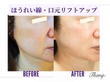 サンク(Thanq)/目の下のたるみ・シワ・クマケア