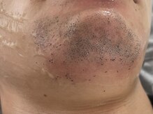 ワレア(Walea)の雰囲気（その場で抜ける！髭脱毛）