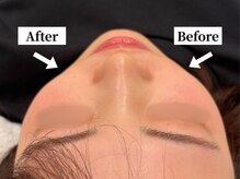 ソレア(Solea)/小顔矯正