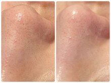 トータルビューティ ノイド(Noid)/毛穴洗浄　いちご鼻撃退