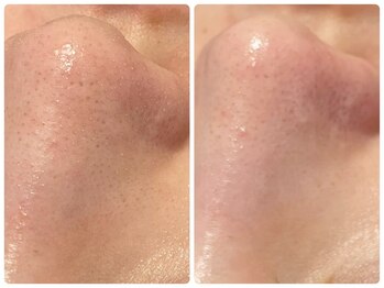 トータルビューティ ノイド(Noid)/毛穴洗浄　いちご鼻撃退