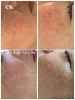 モフ(mof.)の写真/≪じっくり集中シミケア☆≫大人女性に人気◎肌本来の力を整えることで自然にクリアな印象へ導きます！