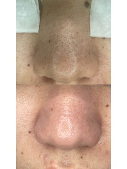 ネイル&アイラッシュ ルミア(Nail & Eyelash LUMIA)/毛穴エクストラクションプロ