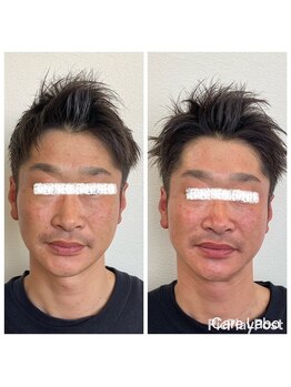 ケアラボ(Care Labo)/【谷口美容鍼】