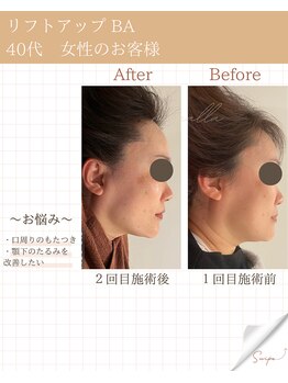 ミーカラー(mecalla.)/リフトアップBA