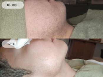 メンズプラス(MEN’S PLUS)/ヒゲ脱毛/ビフォーアフター写真