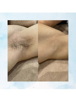 テトテ(tetote)/脇脱毛