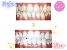 エクシアホワイトニング 天王寺店/ホワイトニングビフォーアフター