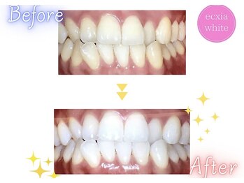 エクシアホワイトニング 天王寺店/ホワイトニングビフォーアフター