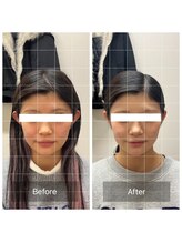 オン鍼灸整体院(ON鍼灸整体院)/美容鍼灸/ビフォーアフター