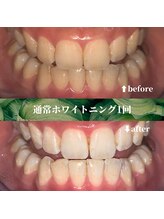 フタバ 天神大名店(futaba)/初回ホワイトニングbefore after