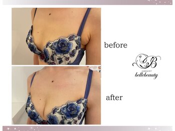 ベルビューティー(belle beauty)/バストアップ◇症例◇