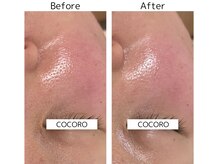 ココロ(COCORO)/プラズマで毛穴ケア