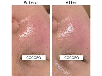 ココロ(COCORO)/プラズマで毛穴ケア