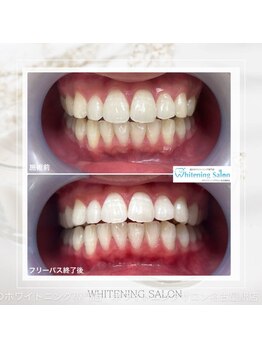 ホワイトニングサロン 名古屋駅店/【ホワイトニング施術例】