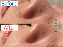 ダーマ(Derma)/毛穴洗浄プレミアムBefore&After
