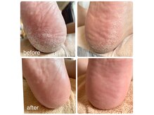 エフ(f)の雰囲気(人に見せたくないガサガサかかともスッキリ☆)