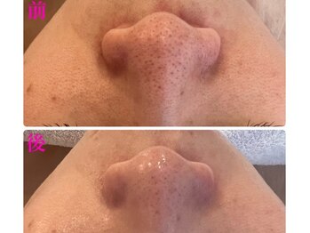 ミラビューティー(Mira Beauty)の写真/大人になって気になる毛穴の開き・黒ずみに◎なめらかツヤ肌へ