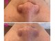 ミラビューティー(Mira Beauty)の写真/大人になって気になる毛穴の開き・黒ずみに◎なめらかツヤ肌へ