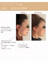 ミーカラー(mecalla.)/リフトアップBA