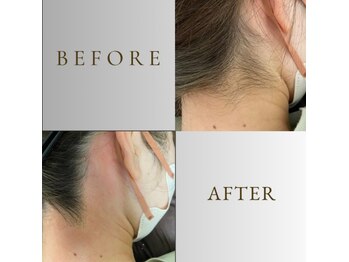 ルナソルビューティーサロン 浜松店(Lunasol)/大人気♪うなじ MIX脱毛