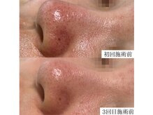 毛穴汚れ・ざらつき　肌質改善