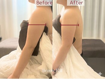 脱毛 痩身ぴゅあら/気になる二の腕すっきり!!