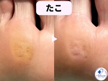 プラスワンフット 本厚木(+1 Foot)/タコ・魚の目ケア！痛みから解放