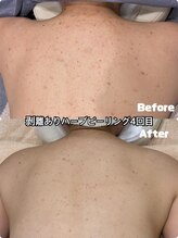 ブロッサム(Blossom)/剥離ありハーブピーリング背中