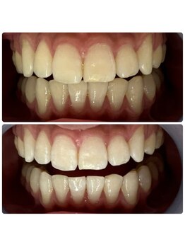 ラブホワイトニング 渋谷店(LOVEホワイトニング)/初回2回照射ホワイトニング