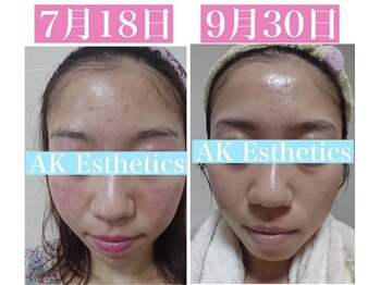 ヴィヴ 熊本(ViV)/【セルマンピーリング】約2ヶ月