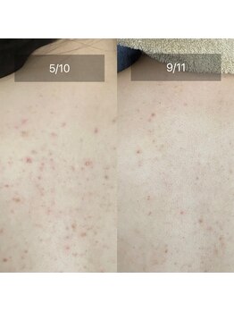 エクラルム(Eclaleum)/BeforeAfter　背中ピーリング