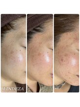 リンデザ(LINDEZA)/脅威の変化