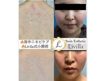 ソワン エステティック リヴィラ(Soin Esthetic Livilla)の雰囲気（小顔・顔肉引き締め・リフトアップ・ほうれい線もお任せ下さい！）
