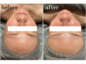 ナーズ(NAZ)/ララピール艶肌コース