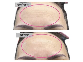 リセル(Recell)/ヒト幹細胞培養上清液導入