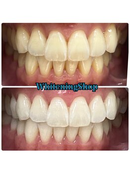 ホワイトニングショップ 津田沼店/before&after美白ホワイトニング