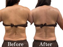 モリタ鍼灸整骨院/【ラジオ波】ボディメイク