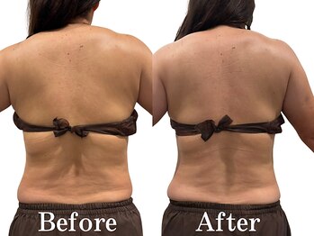 モリタ鍼灸整骨院/【ラジオ波】ボディメイク